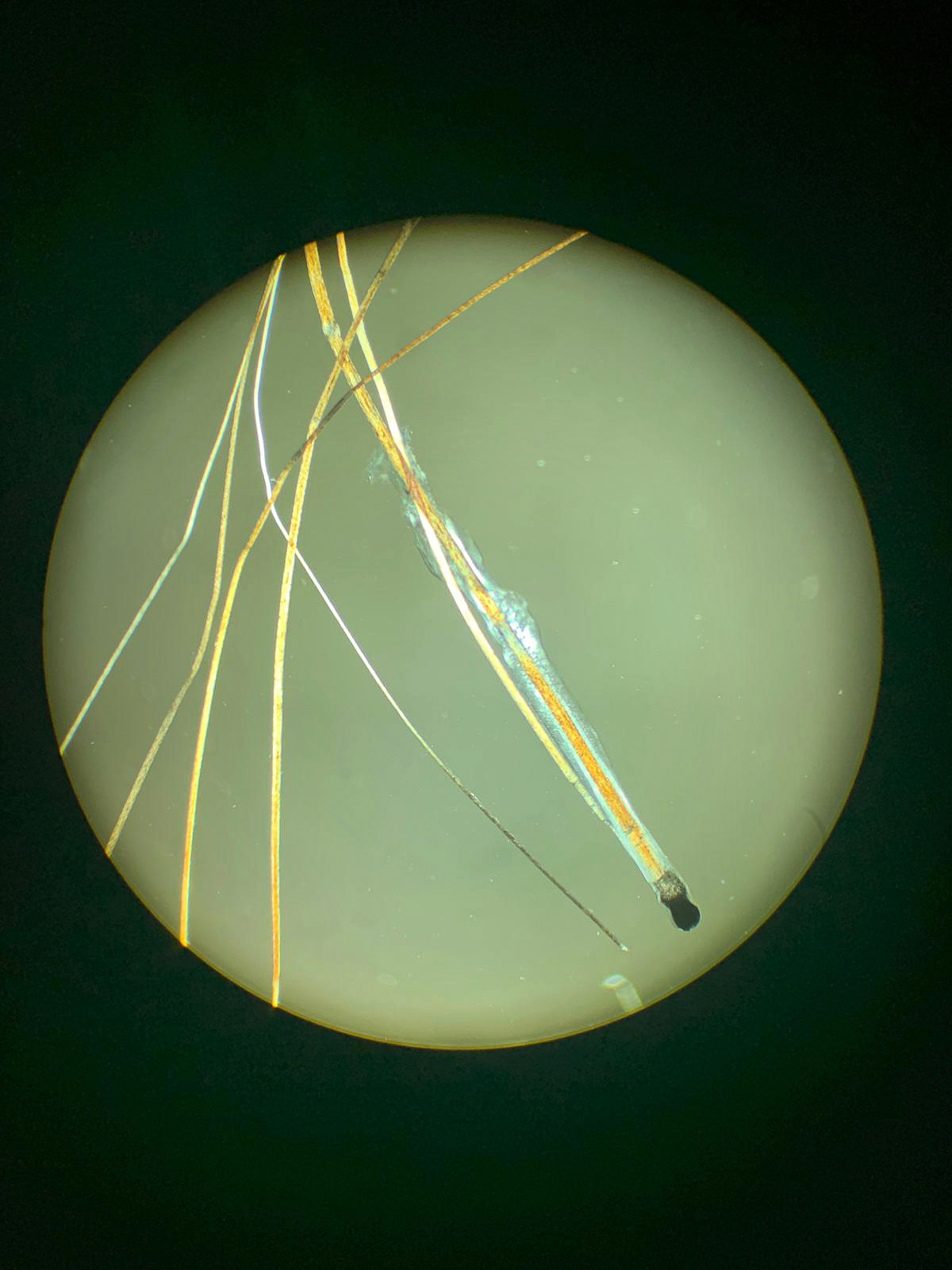 Capelli al microscopio a luce polarizzata: anagen distrofici e preminiaturizzati