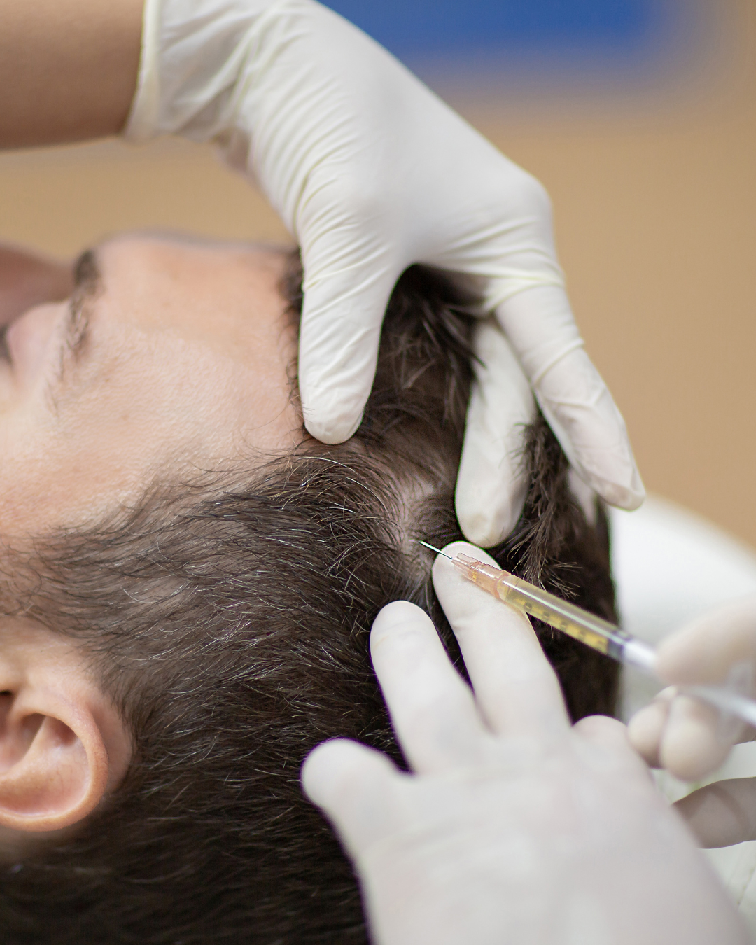 dottore che effettua iniezione con siringa nel cuoio capelluto