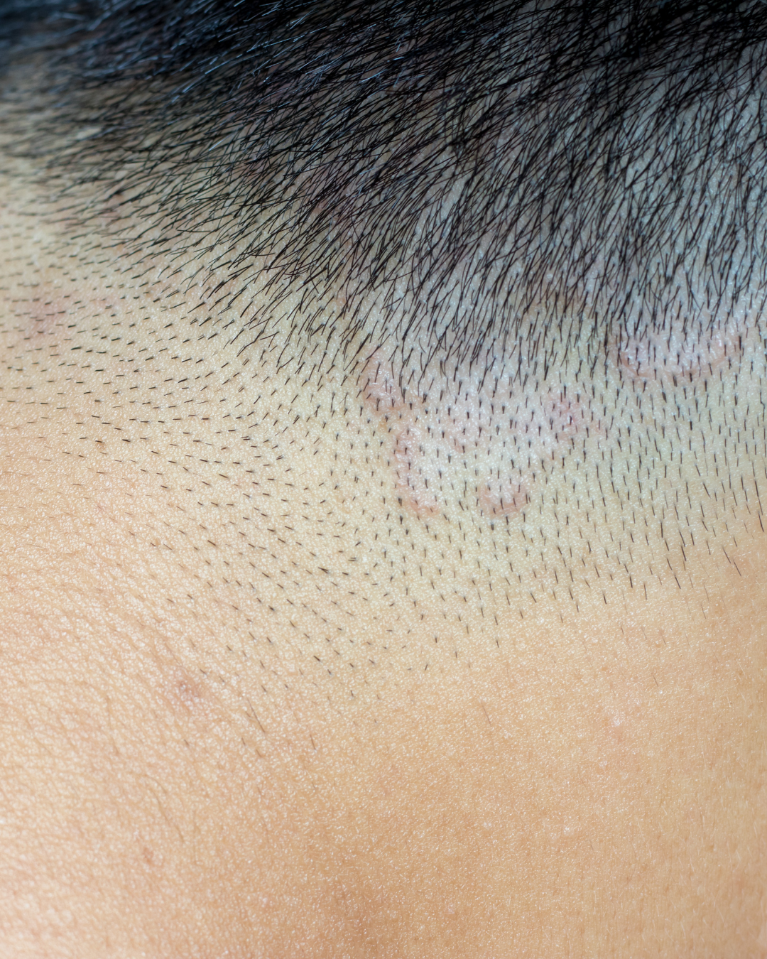 dermatite seborroica sulla cute sotto i capelli