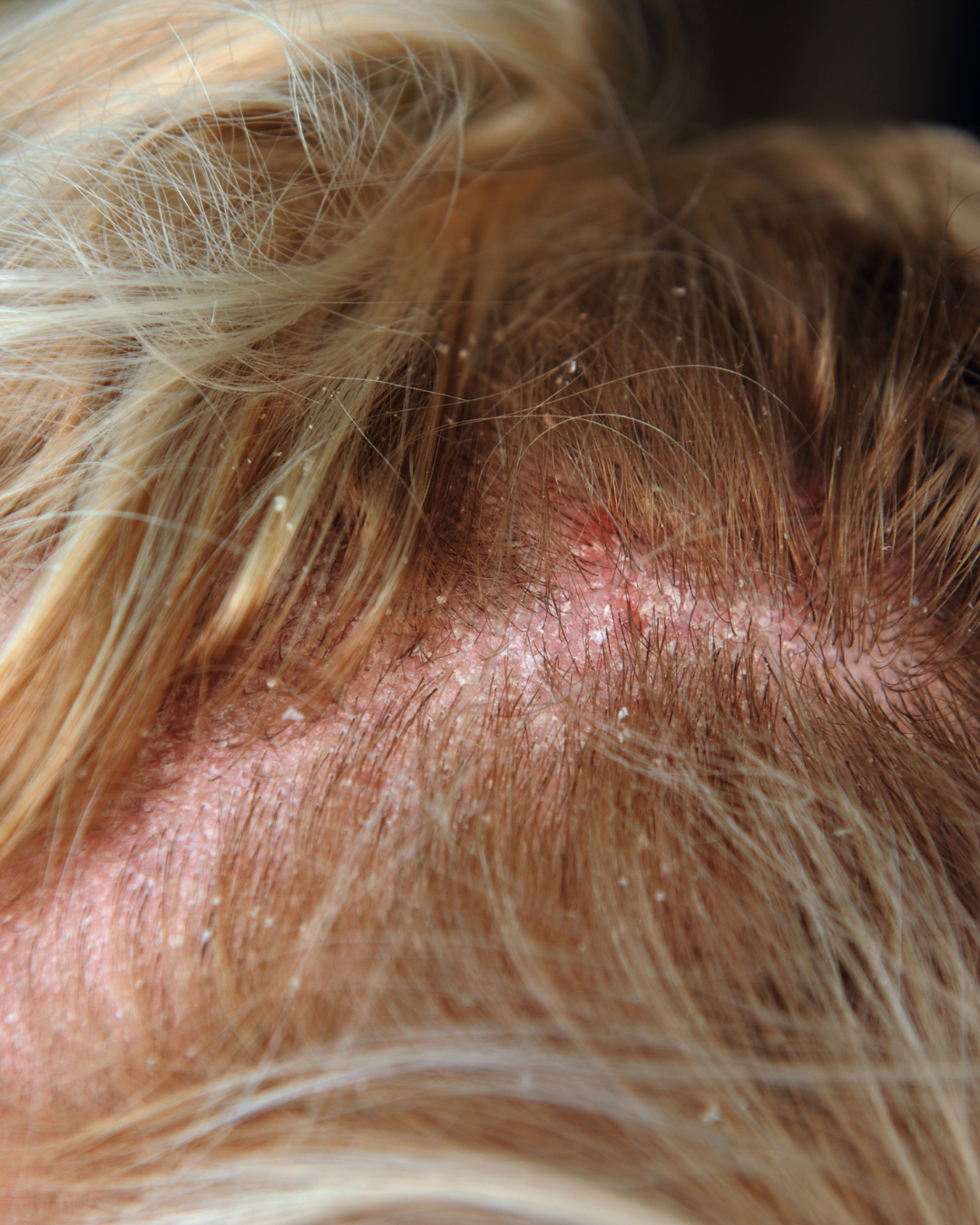 dermatite seborroica sulla cute sotto i capelli